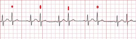 Questionario: 3 Paziente portatore di PM bicamerale; storia di FA parossistica. Si presenta in PS con questo ECG Quale dei seguenti misure è più utile mettere in atto? 1.