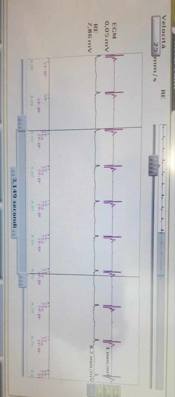 Questionario 6 Al controllo del dispositivo: Nel registro aritmie risulta in corrispondenza dell ECG controllo della soglia automatica In ambulatorio si esegue test della soglia automatica: all ECG