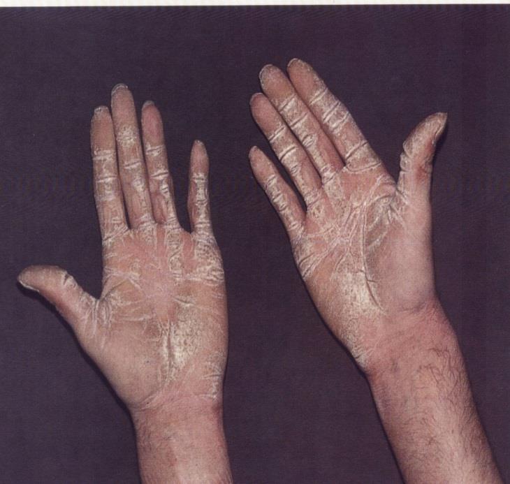 vitiligo ulcera