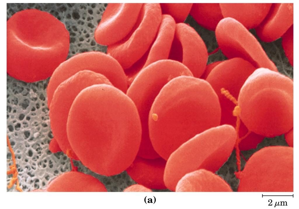 ANEMIA FALCIFORME Particolare forma di anemia descritta per la prima volta all inizio del secolo.