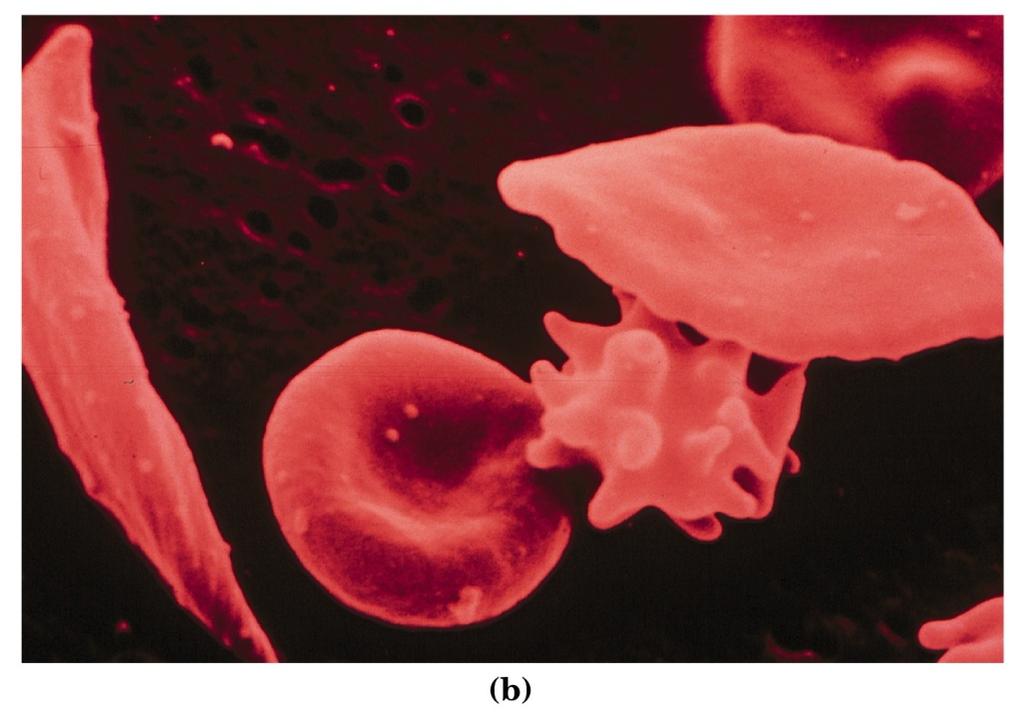 Gli individui affetti da anemia a cellule falciformi sono omozigoti per un gene anormale autosomico.
