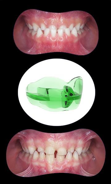 CASO DI TERZA CLASSE ELASTIC ORTHODONTIC REHABILITATION SYSTEM Elastodonzia: un nuovo approccio in ortodonzia, protesi e conservativa con i Bio-Attivatori AMCOP ELASTODONTIC THERAPY - DR.