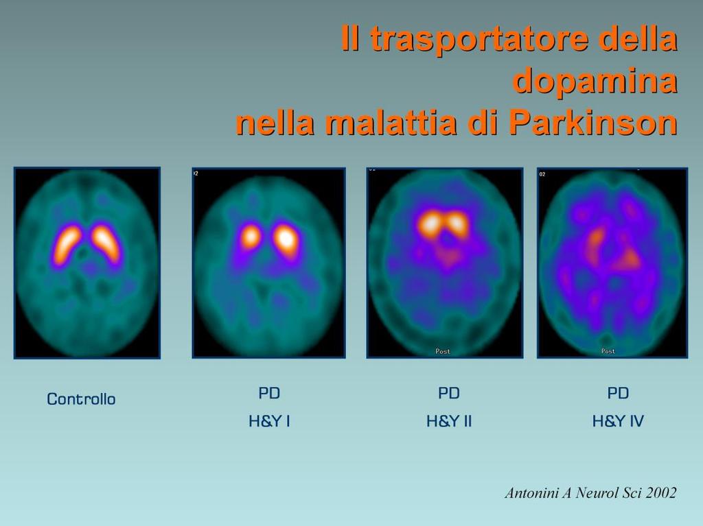 Studio SPECT del trasportatore della dopamina con DaTSCAN in un controllo sano (immagine a sinistra) e in pazienti con diverso gradi di compromissione motoria.