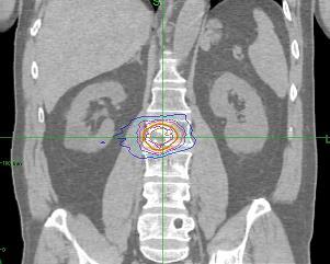 Cyberknife nella pratica clinica da 02/2012-1 trattamento - boost - re-irradiazione -