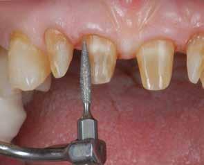 1) FIG. 1 FIG. 2 Un ausilio importantissimo arriva dall utilizzo degli strumenti ultrasonici, già ampiamente utilizzati e testati sulle preparazioni con margine di finitura.