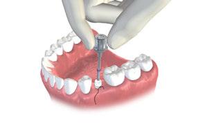 Fase 4 Montaggio Inserire la vite di fissaggio e stringere a mano. Utilizzare il cacciavite Straumann SCS. Verificare l adattamento ed eventuale gioco rotazionale o verticale.