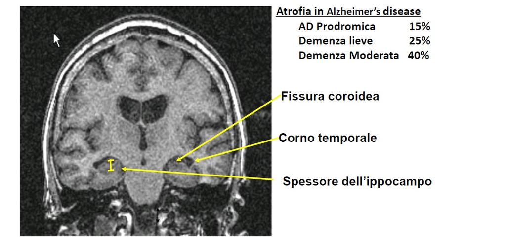 2) Uno specifico profilo di atrofia