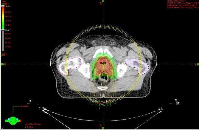 Radioterapia con tecnica Rapid Arc di un tumore della