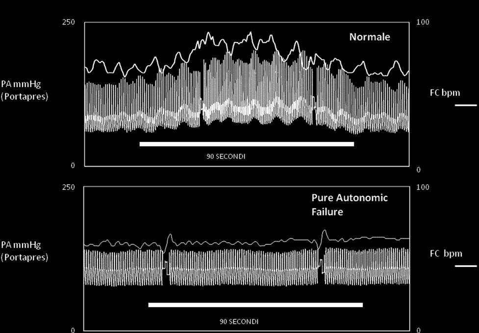 Figura 12: Risposta pressoria al freddo (Mathias CJ, 2013) Iperventilazione Il paziente è mantenuto in clinostatismo a riposo per almeno 2 minuti o per il tempo necessario affinché FC e PA tornino a