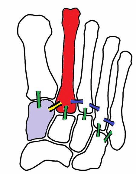 CENNI DI ANATOMIA La base del secondo metatarso è strettamente incassata in una struttura ad incastro, formata dal cuneiforme mediale e dal laterale; poiché questa disposizione blocca l intera