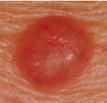 Carcinoma basocellulare È il tipo di tumore della pelle più frequente, ma anche il meno pericoloso.