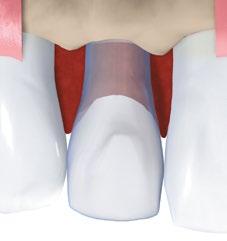 3.1.1.1 Esempi relativi a lacune di denti singoli In caso di ricostruzione di denti singoli, l impianto viene collocato in posizione centrale all interno della lacuna.