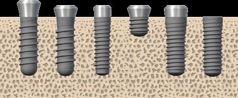 3.1.3 Posizione corono-apicale dell impianto Gli impianti dentali Straumann consentono il posizionamento flessibile di impianti corono-apicali a seconda dell anatomia individuale, del sito