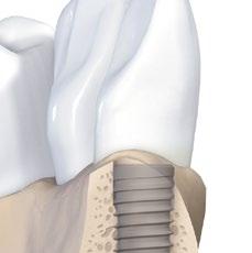 Impianti Straumann Bone Level La migliore collocazione degli impianti Straumann Bone Level è garantita se il margine esterno del piccolo bordo inclinato di 45 (chamfer) si trova a livello dell osso.