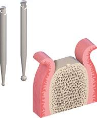 4.1.1 Preparazione di base del letto implantare Dopo avere aperto la gengiva, la preparazione di base del letto implantare inizia con la preparazione della cresta alveolare (passo 1) e la