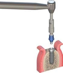 Usare la Chiavetta di Ritegno per contrastare il movimento dell ottagono e allentare la Componente di Transfer in senso antiorario servendosi del Cricchetto (per maggiori dettagli sulla Chiavetta di