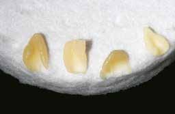 Dentina A3 + Modificatori della dentina arancione + giallo Dentina A3 Dentina A2 Le nuove masse individuali, traslucenti, intensive (CTI) permettono di far risaltare gli