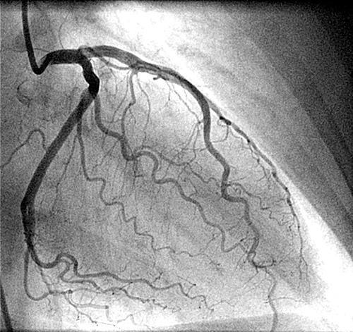 Angiografia coronarica e periferica Ateromasia calcifica