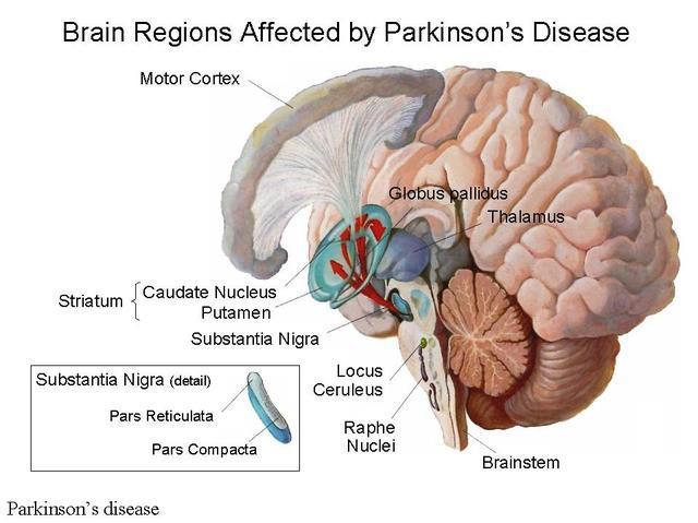 Morbo di Parkinson: Cause Misfolding dell alfa-sinucleina e della parkina Disfunzione mitocondriale e stress ossidativo