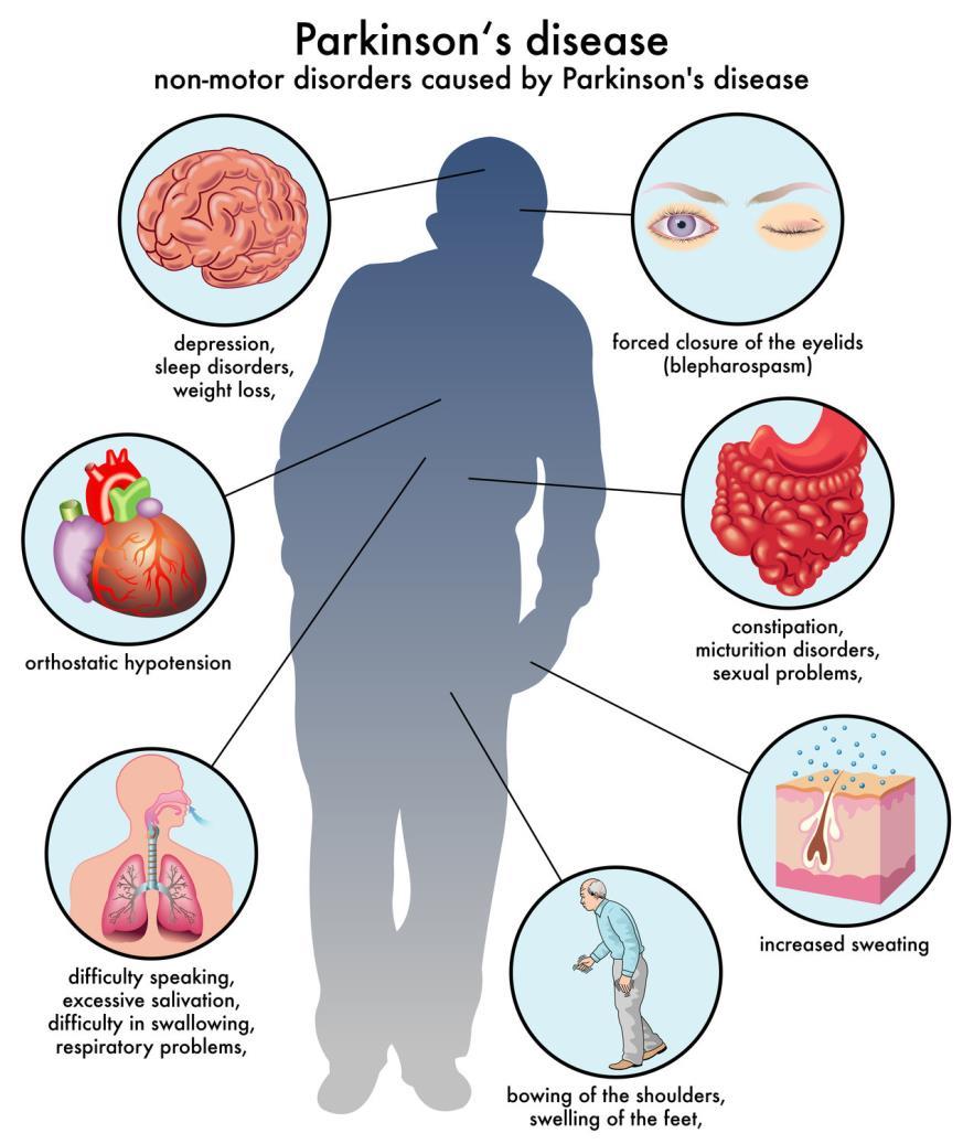 Morbo di Parkinson: Fattori di Rischio Sesso maschile Età Esposizione a sostanze tossiche