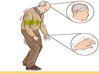Morbo di Parkinson: Sintomatologia Bradicinesia Rigidità Tremore a