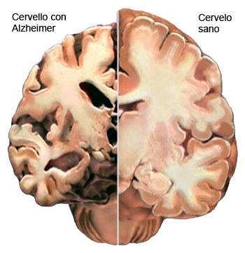 Malattia Di Alzheimer: Cause Accumulo di aggregati di proteine errate all interno e all esterno dei