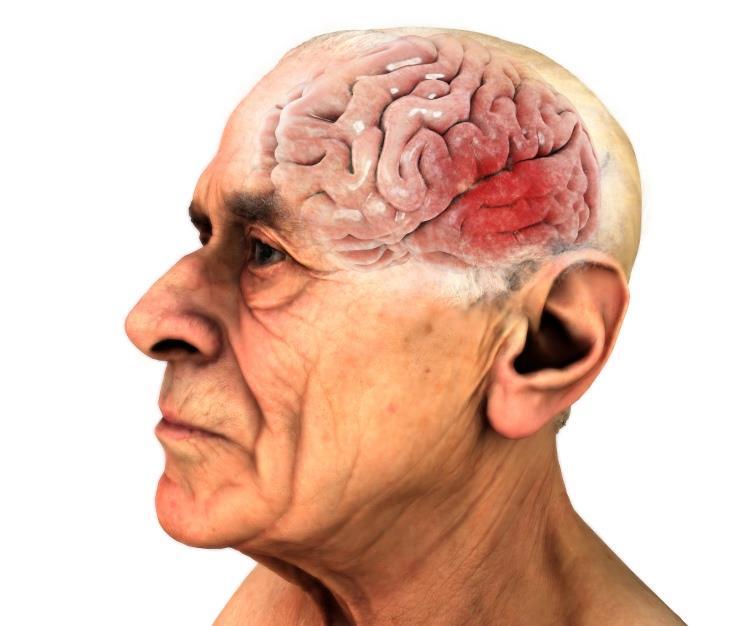 Malattia Di Alzheimer: Sintomatologia Sintomi cognitivi
