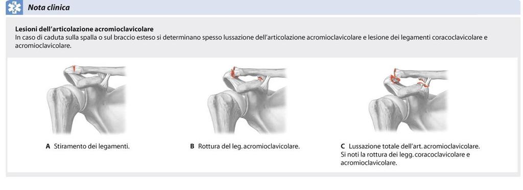 Lesioni/distorsioni e Lussazione dell articolazione Acromio-Clavicolare Danni traumatici a carico delle articolazioni Distorsione/slogatura