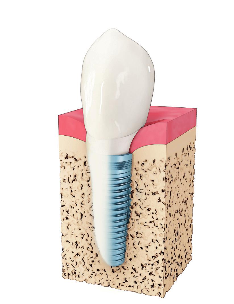 Gli impianti dentali offrono diversi vantaggi Cos'è un impianto dentale? Un impianto dentale funge da radice del dente nuovo.