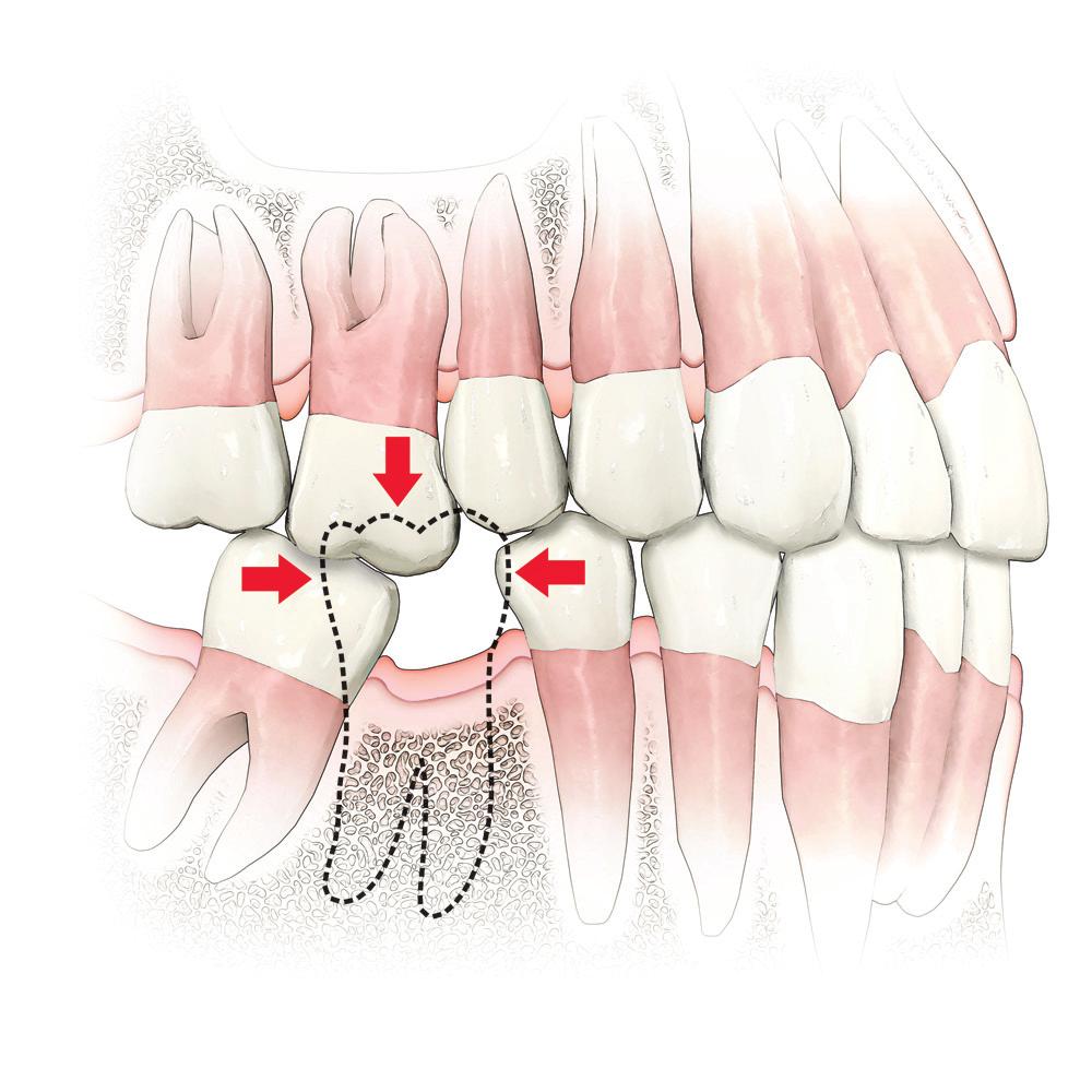 Importanza di una dentatura sana La perdita o il danneggiamento anche di un solo dente può influenzare la tua vita quotidiana. Può influire sulla tua salute generale, sull'aspetto e sull'autostima.