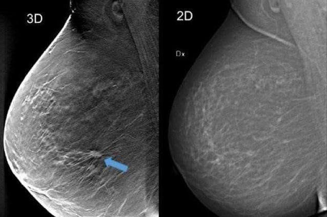 Carcinoma mammario Screening: 1 mammografia ogni 2 anni dai 50 ai 69 anni Sintomi: nodulo, e c z e m a o sanguinamento dal capezzolo, mastalgia zonale