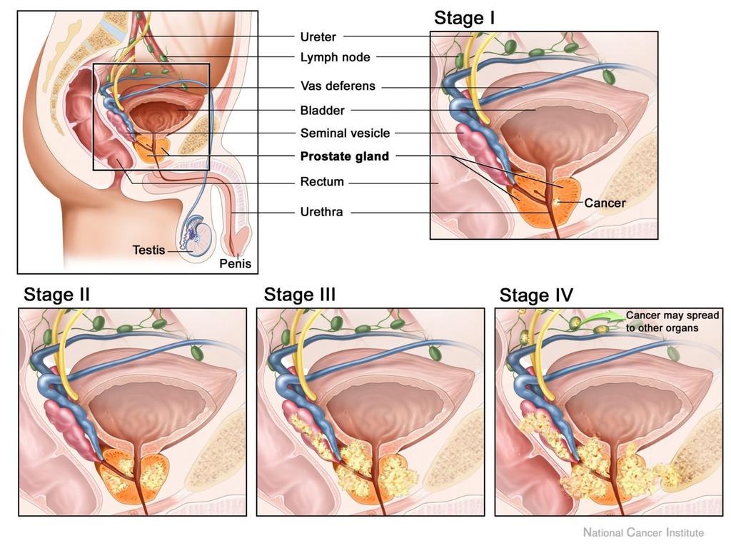 Carcinoma della prostata Sintomi: assenti, ematospermia (sangue nello sperma), ematuria, dolori ossei Diagnosi clinica: anamnesi,