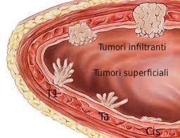 Carcinoma della vescica Sintomi: ematuria, facilità