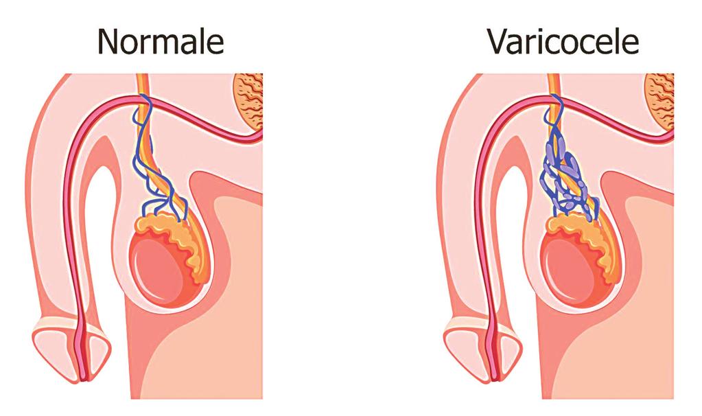 2.6 VARICOCELE Il varicocele è una patologia caratterizzata da una dilatazione delle vene che drenano in testicolo.