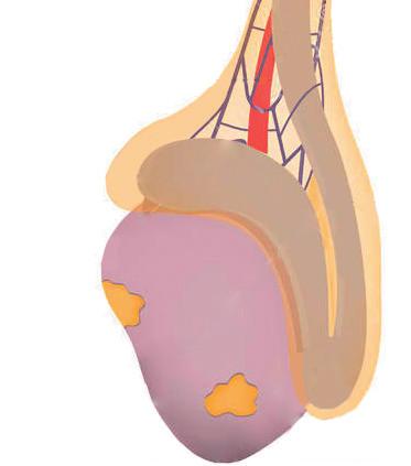 3. TUMORE DEL TESTICOLO ED AUTOPALPAZIONE Il tumore del testicolo è la neoplasia più frequente nel maschio tra i 15 e i 35 anni ed è in aumento negli ultimi anni.