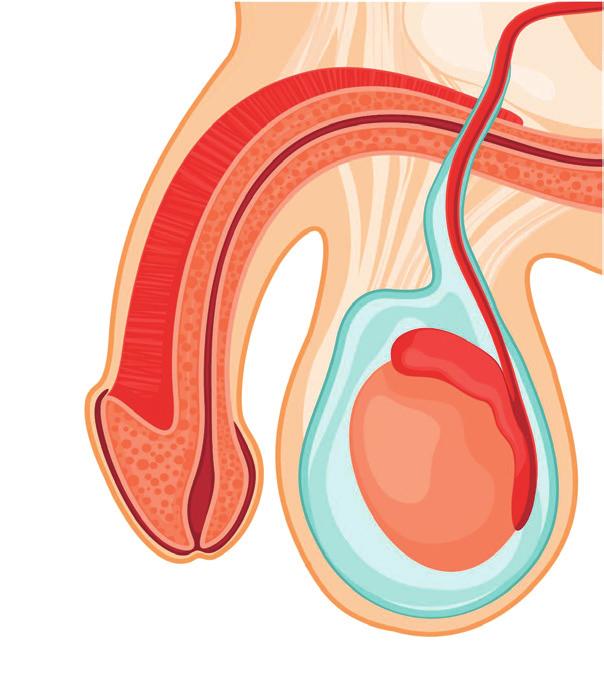 2.3 IDROCELE L idrocele è una raccolta di liquido sieroso nello scroto ed è la causa più comune di tumefazione scrotale nell adolescente. Raramente dà dolore ed è più frequente nell emiscroto di dx.