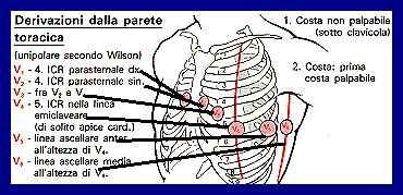 Elettrodo Repere Registrazione attività cardiaca V1 (elettrodo rosso): nel 4 spazio parasternale destra V2 (elettrodo giallo): nel 4 spazio parasternale sinistra Setto Setto V3 (elettrodo verde): tra