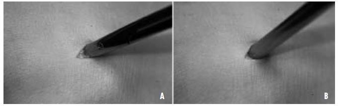 Piede intraruotato, si palpa il seno del tarso (a) e si esegue a questo livello un incisione di circa 1cm (b).