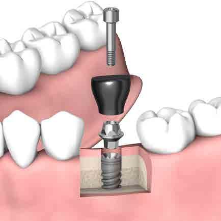 3 4 Opzionale Impianto con abutment di guarigione Presa d impronta
