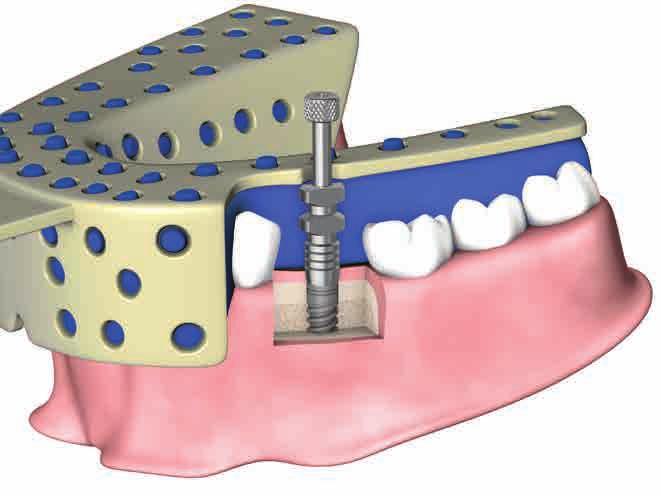 Riabilitazione su dente singolo Sitema di abutment HC Il sistema di abutment HC comprende abutment Ø4.
