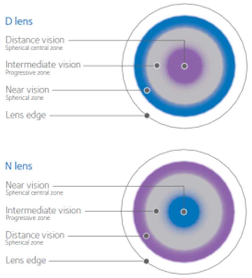 Queste lenti possono essere applicate con una riduzione del potere di addizione in uno dei due occhi, indirizzandosi verso la tecnica definita monovisione modificata.