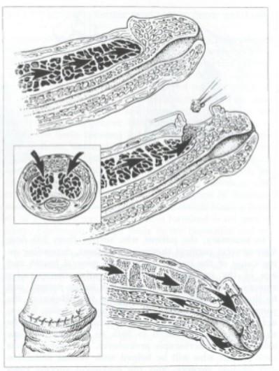 Chirurgia degli Shunt Penieni A l G h o r a b s t e c h n i q u e : consiste nell exeresi bilaterale di un cono di albuginea a livello dell apice