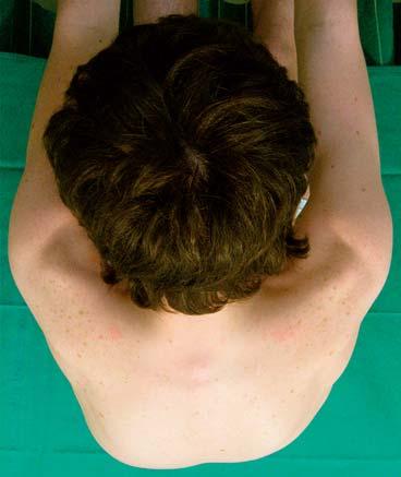 Il gibbo nella scoliosi Il gibbo posteriore nel paziente scoliotico è una salienza delle coste o dei muscoli paravertebrali lombari, comunemente dal lato convesso della curva scoliotica, che degrada