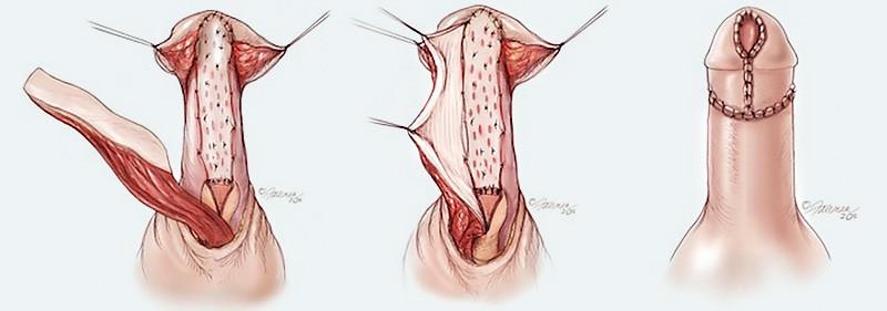 Trattamento uretra anteriore Uretroplastica La chirurgia