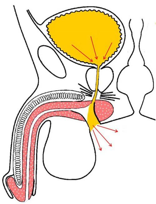 Trattamento uretra anteriore Perineostomia E possibile indicare una perineostomia al posto di una uretroplastica in casi selezionati Stenosi dell uretra anteriore ricorrenti e complesse Età avanzata