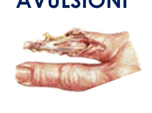 AVULSIONI