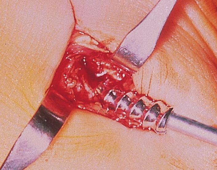 B- Con l apposito perforatore (Ø 4 mm) si esegue un foro nel calcagno partendo dall angolo antero-inferiore in direzione del seno del tarso e precisamente del margine anteriore del processo laterale