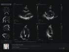 - Analisi completa del ventricolo sinistro - Vista simultanea di più sezioni delle camere con informazioni sulla contrattilità dei
