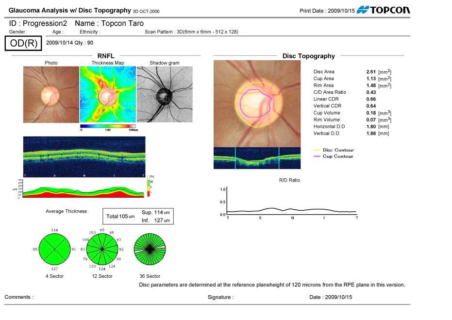 Analisi Glaucoma - 3D Solo questo