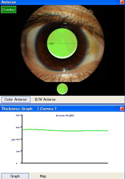 1 Spessore corneale centrale